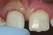 小心地将撞落的牙齿放回原位，并立即到牙医处求助