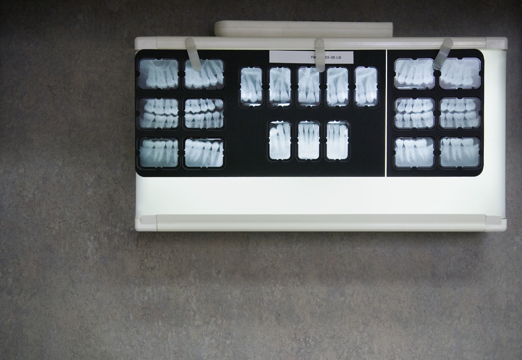 拍牙科X光片的价值