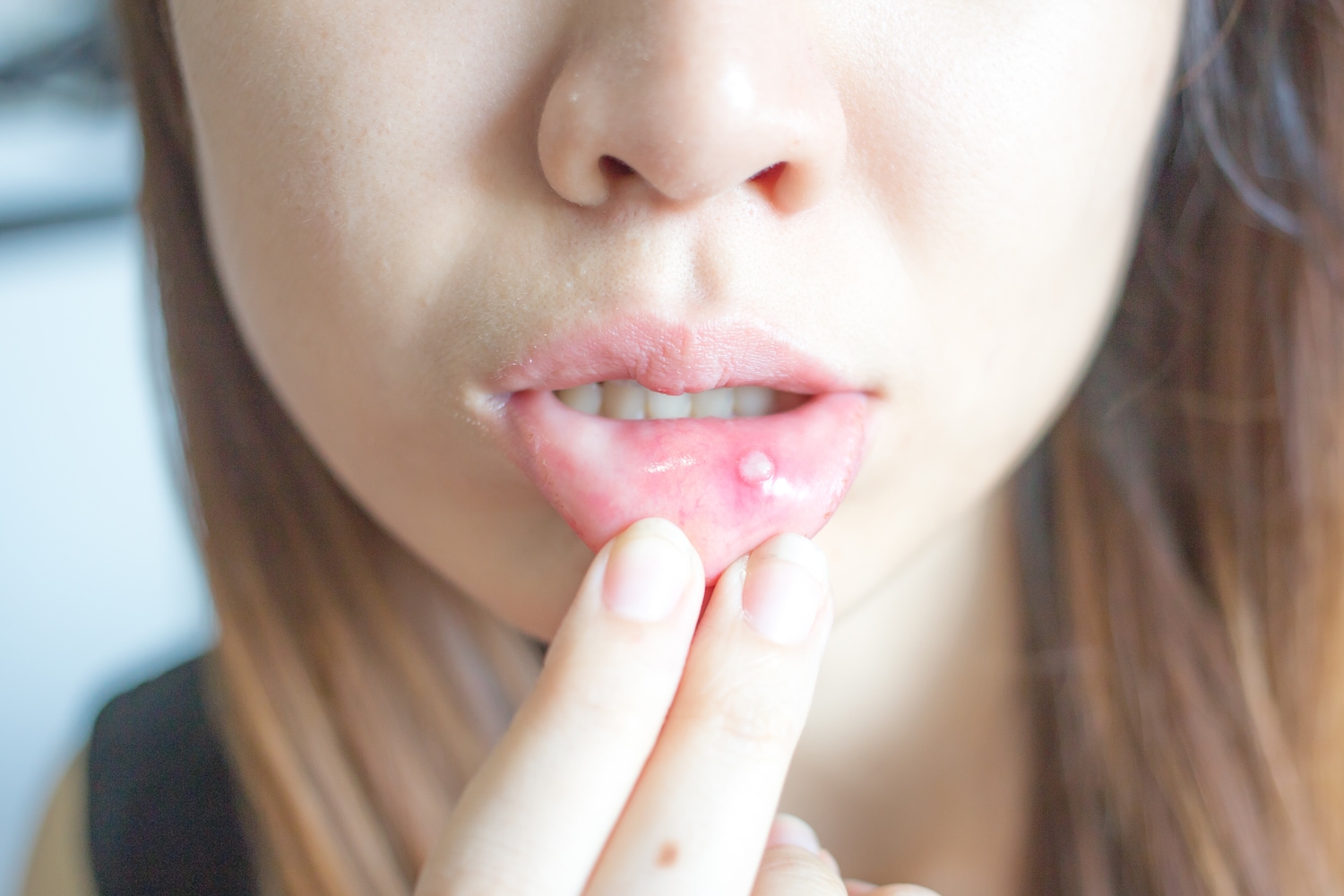 口腔溃疡和唇疱疹