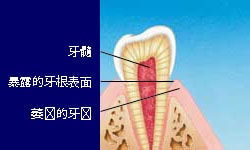 敏感的牙齿1